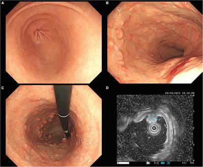Type-1 Grade 2 Multi-Focal Gastric Neuroendocrine Tumors Secondary to Chronic Autoimmune Gastritis